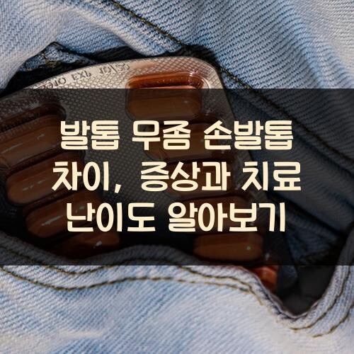 발톱 무좀 손발톱 차이, 증상과 치료 난이도 알아보기